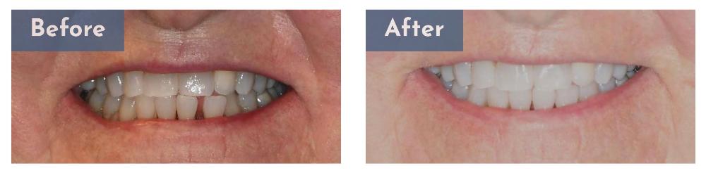 before and after clear aligners | clear aligners bellevue tn