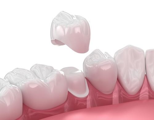 dental crown on tooth | dental crowns bellevue