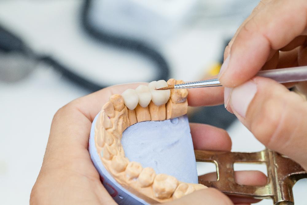 dental implant in jaw model | dental implants bellevue tn
