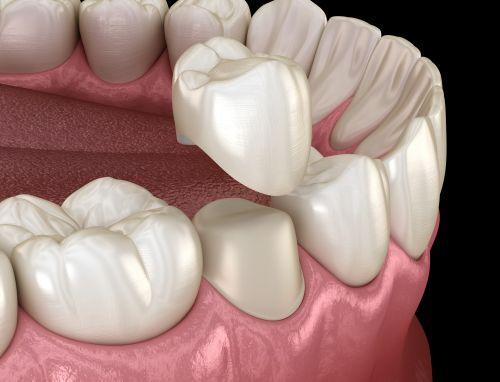 close up of dental crown on tooth | same day dental crowns bellevue tn