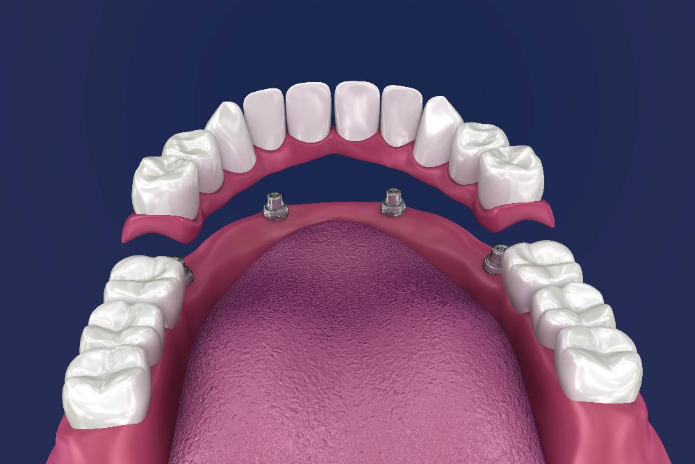close up of lower dental bidge | dental bridges bellevue tn