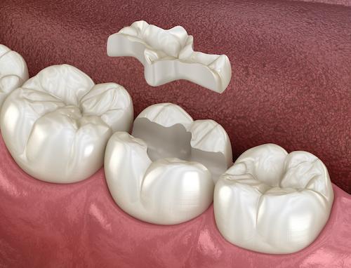 close up of onlay going on tooth | dentist nashville