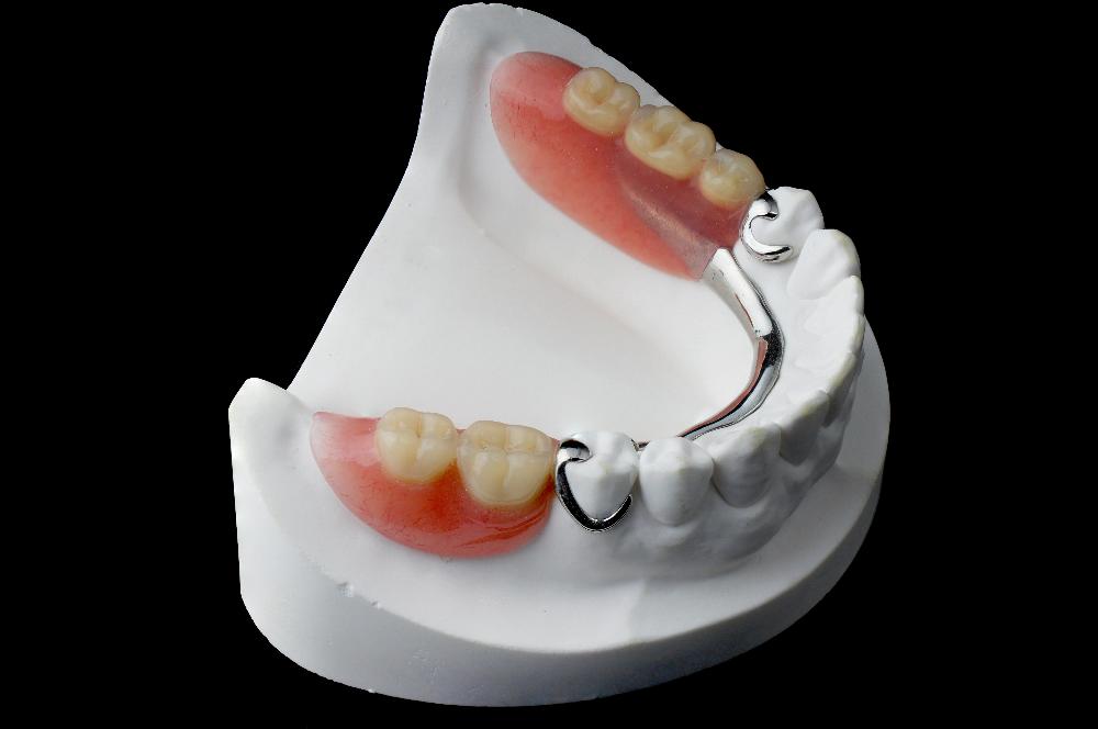 close up of partial denture | implant dentures bellevue tn
