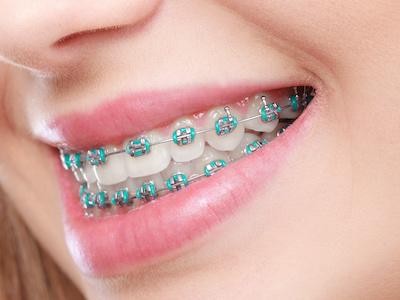patient with traditional braces | dentist bellevue tn