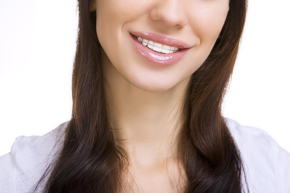 woman wearing clear plastic aligner | orthodontics bellevue