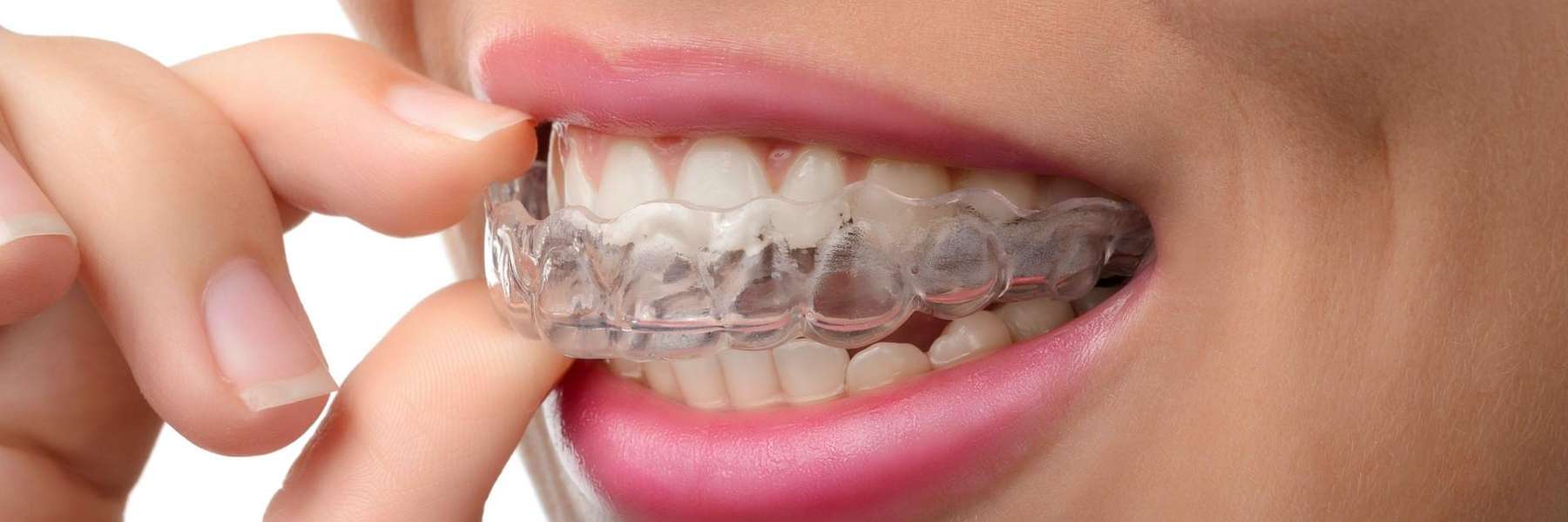 patient putting in clear plastic aligner | clear aligners bellevue