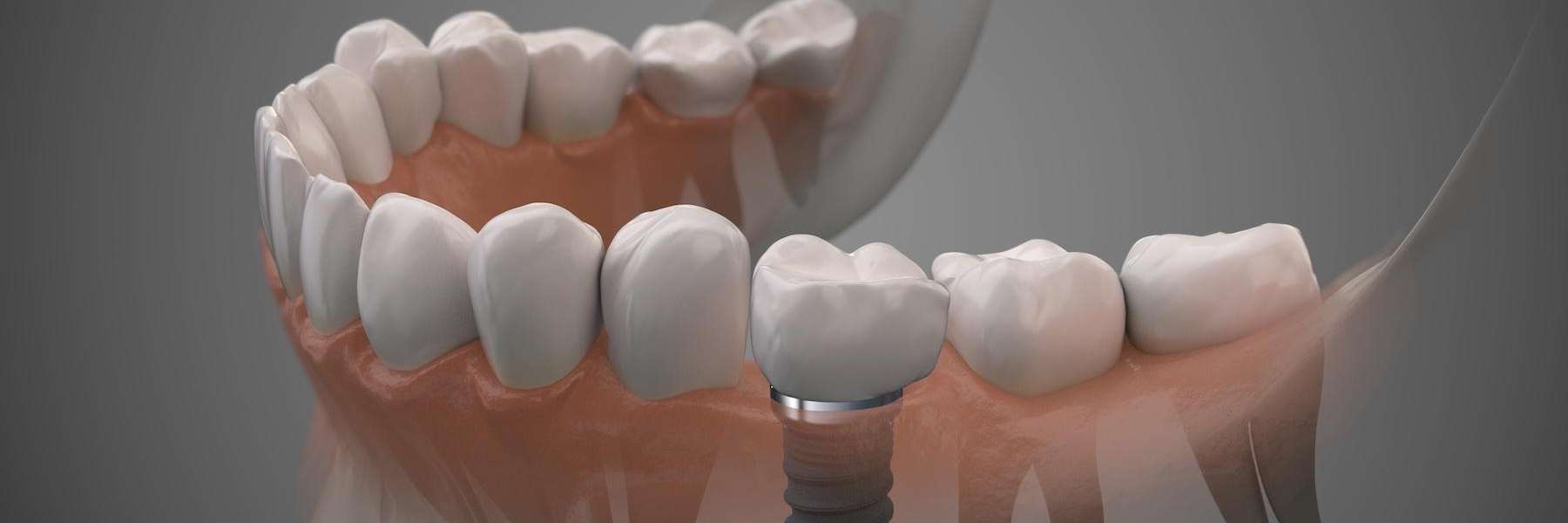 close up of dental implant in lower jaw | dentist bellevue tn