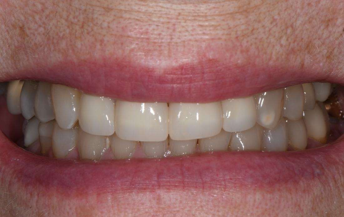complete smile after dental treatment | bellevue tn dentist