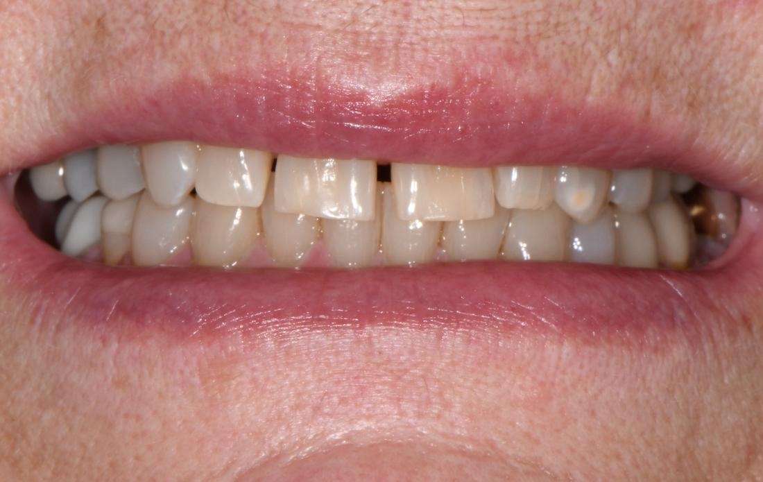 gapped front tooth before treatment | cosmetic dentist bellevue tn