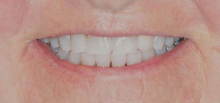 Clear-Aligners-Before-After-After-Image