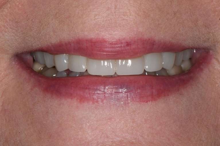 Dental-Restorations-Before-After-After-Image
