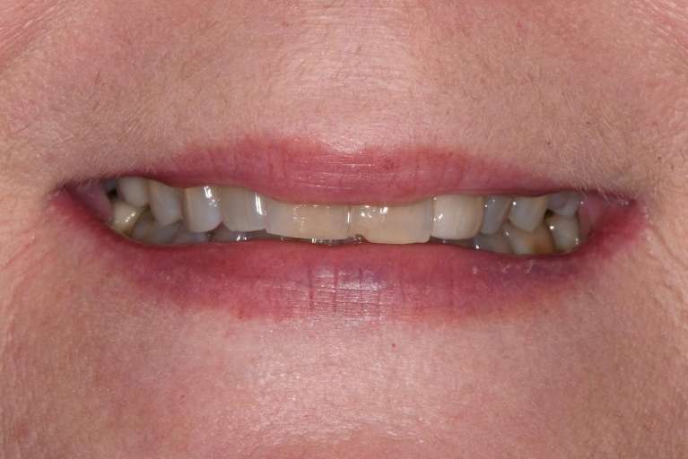 Dental-Restorations-Before-After-Before-Image