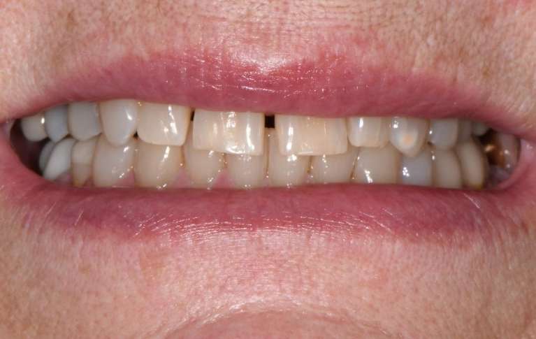 Spacing-Wear-and-Color-Before-Image